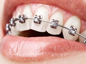 ortodontia-autoligados