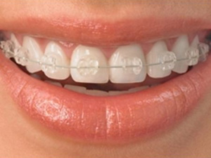 ortodontia-porcelana